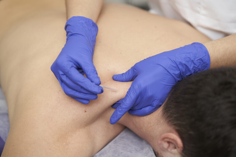 Dry needling physical therapy treatment for muscle pain